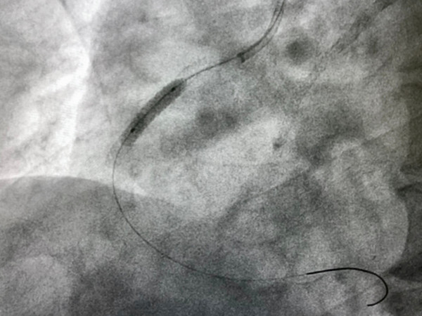Medical fine wire | Plansee